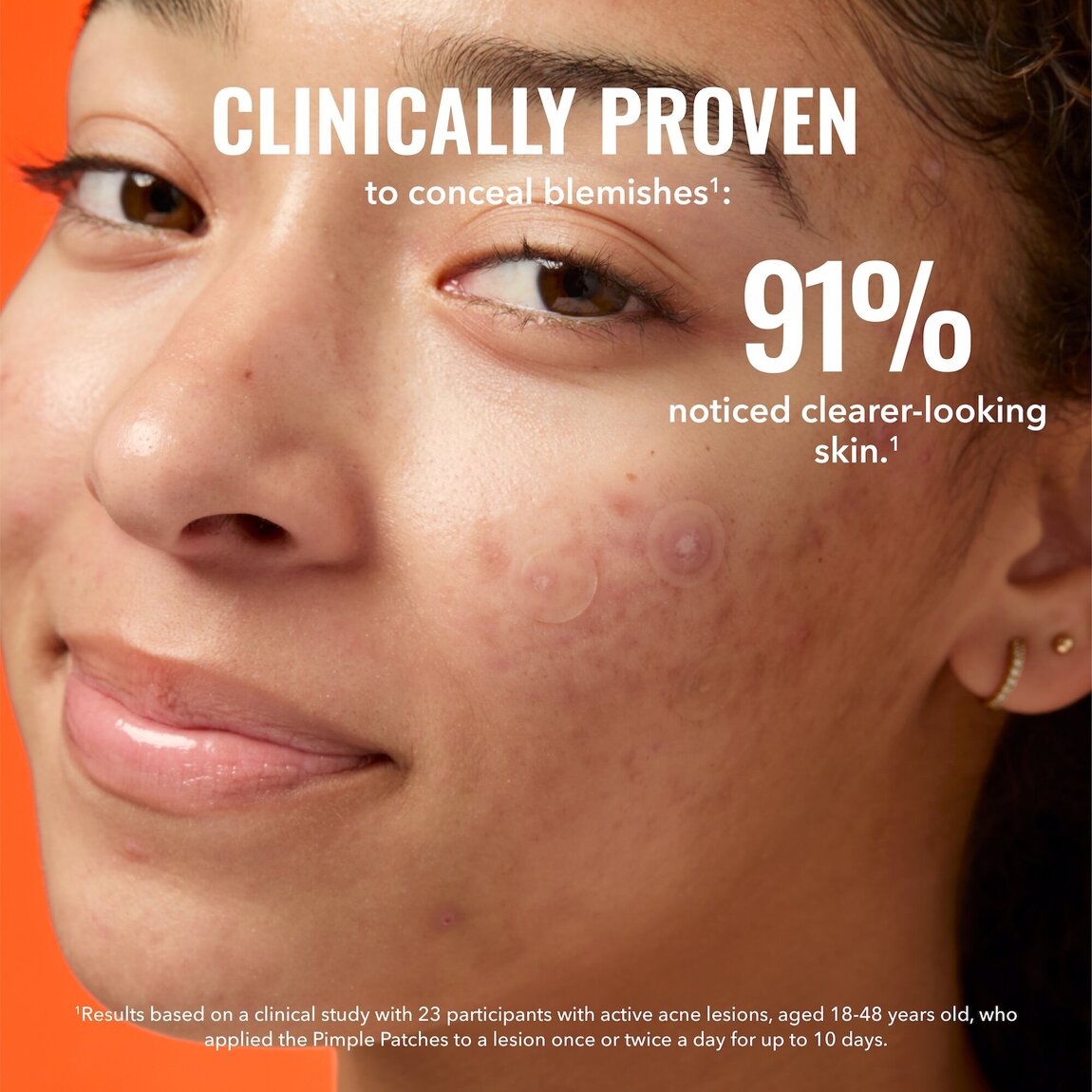 pimple-patches-z8 zb_p.jpg