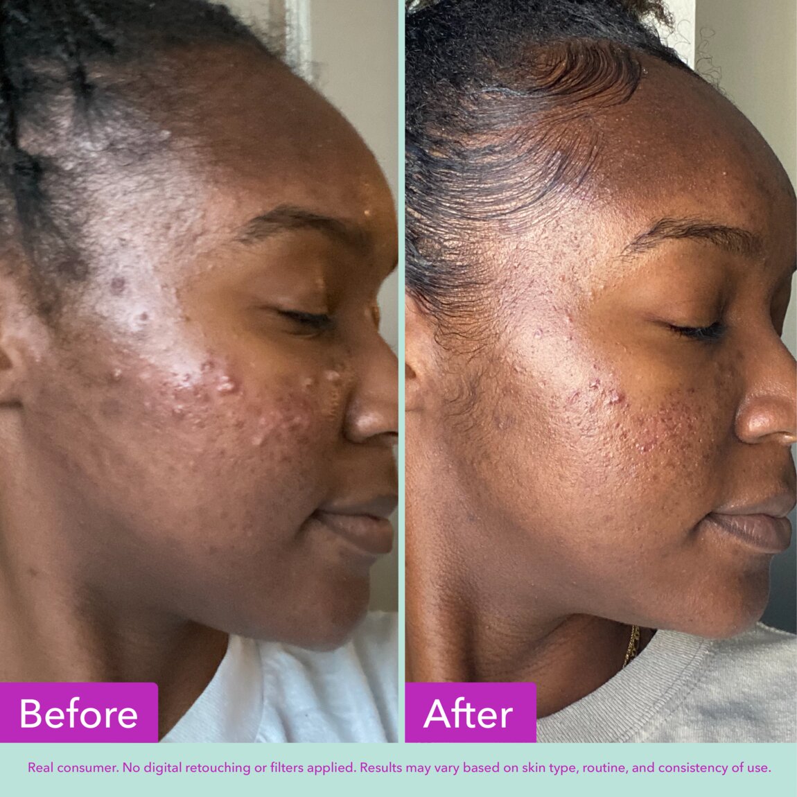 acne-foaming-cleanser-z0 zb_p.jpg